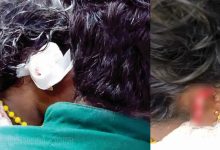 Photo of തെരുവുനായ ആക്രമണം; ചെവി നഷ്ടപ്പെട്ട മൂന്ന് വയസ്സുകാരിയുടെ ശസ്ത്രക്രിയ വിജയകരം