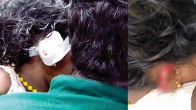 Photo of തെരുവുനായ ആക്രമണം; ചെവി നഷ്ടപ്പെട്ട മൂന്ന് വയസ്സുകാരിയുടെ ശസ്ത്രക്രിയ വിജയകരം