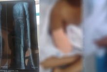 Photo of ഒമ്പത് വയസ്സുകാരിയുടെ കൈ മുറിച്ചുമാറ്റിയ സംഭവം; കുട്ടിയുടെ കുടുംബം പോലീസില്‍ പരാതി നല്‍കി