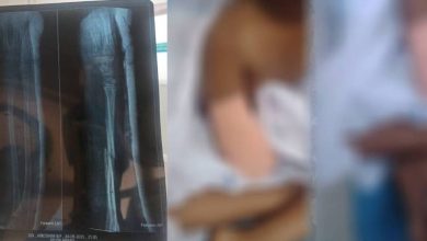 Photo of ഒമ്പത് വയസ്സുകാരിയുടെ കൈ മുറിച്ചുമാറ്റിയ സംഭവം; കുട്ടിയുടെ കുടുംബം പോലീസില്‍ പരാതി നല്‍കി